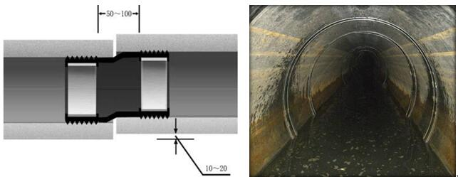 不锈钢双胀圈修复